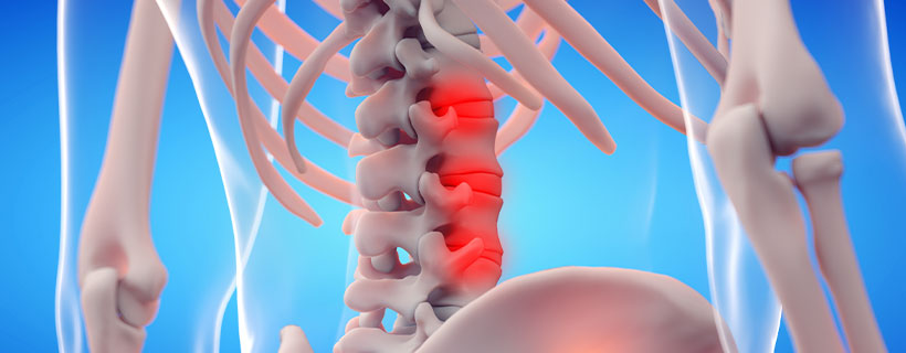 patient needing ankylosing spondylitis treatment in Monterey