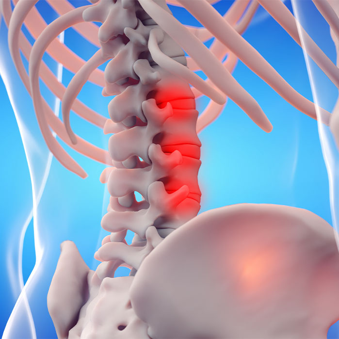 ankylosing spondylitis chiropractor in Monterey, CA