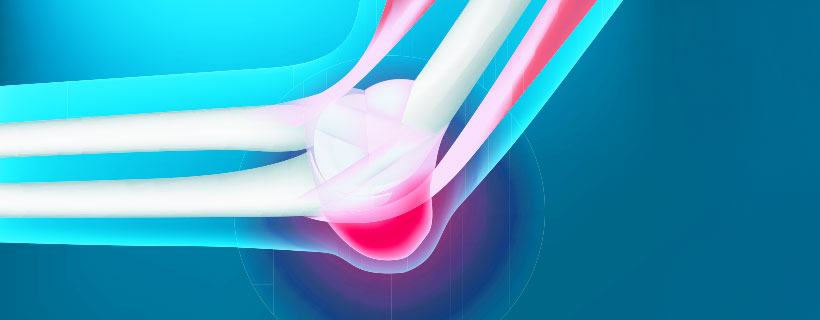 patient needing bursitis treatment in Monterey
