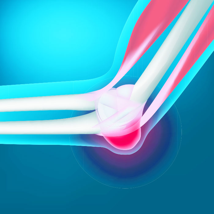 bursitis chiropractor in Monterey, CA