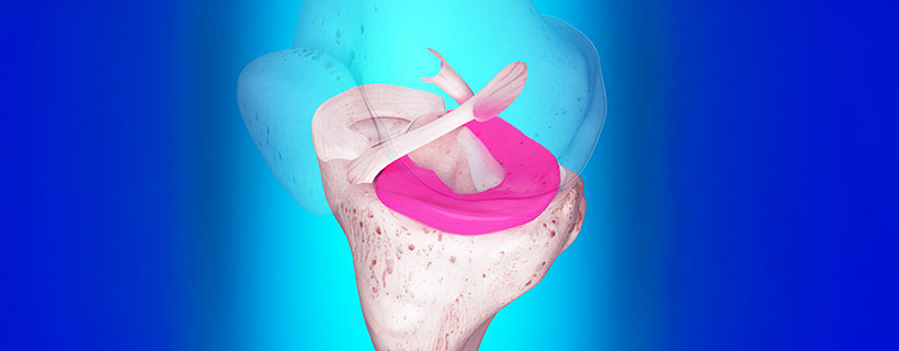 patient needing ligamentitis treatment in Monterey