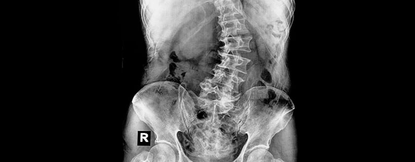 patient needing scoliosis treatment in Monterey
