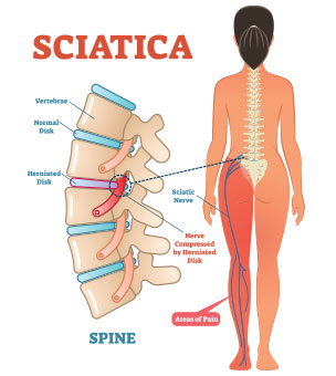 sciatica chiropractor in Monterey, CA